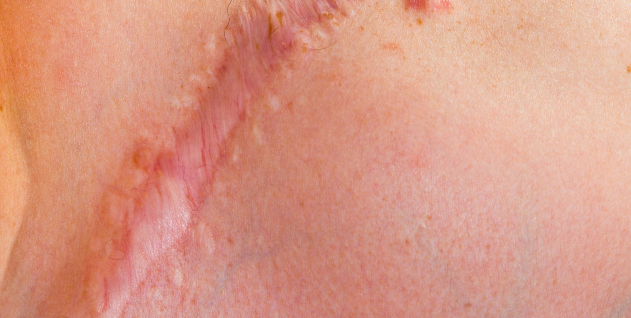 Blizny – czy i jak je usuwać? 